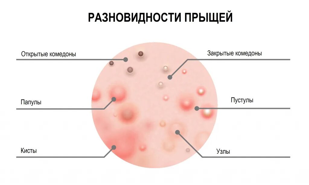 Разновидности герпеса на теле фото и описание Прыщи на лице - причины появления, при каких заболеваниях возникает, диагностика