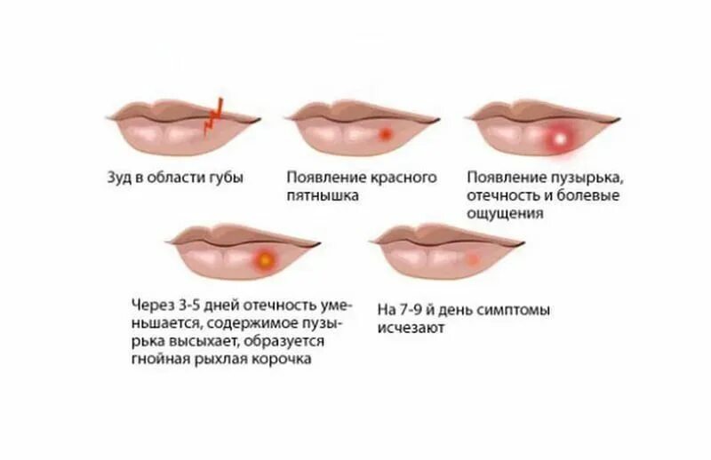 Разновидности герпеса на теле фото и описание Чем быстро вылечить герпес на губах