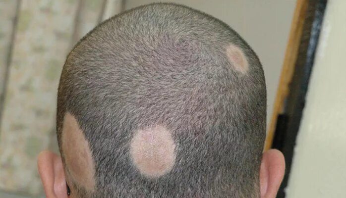 Разновидности лишая на голове фото Pin on Androgenetic Alopecia