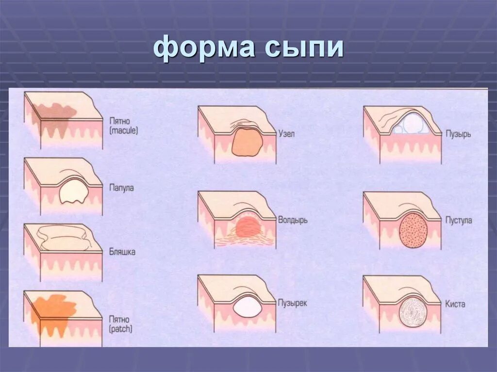 Разновидности сыпи с фото и описанием Первичные полостные элементы