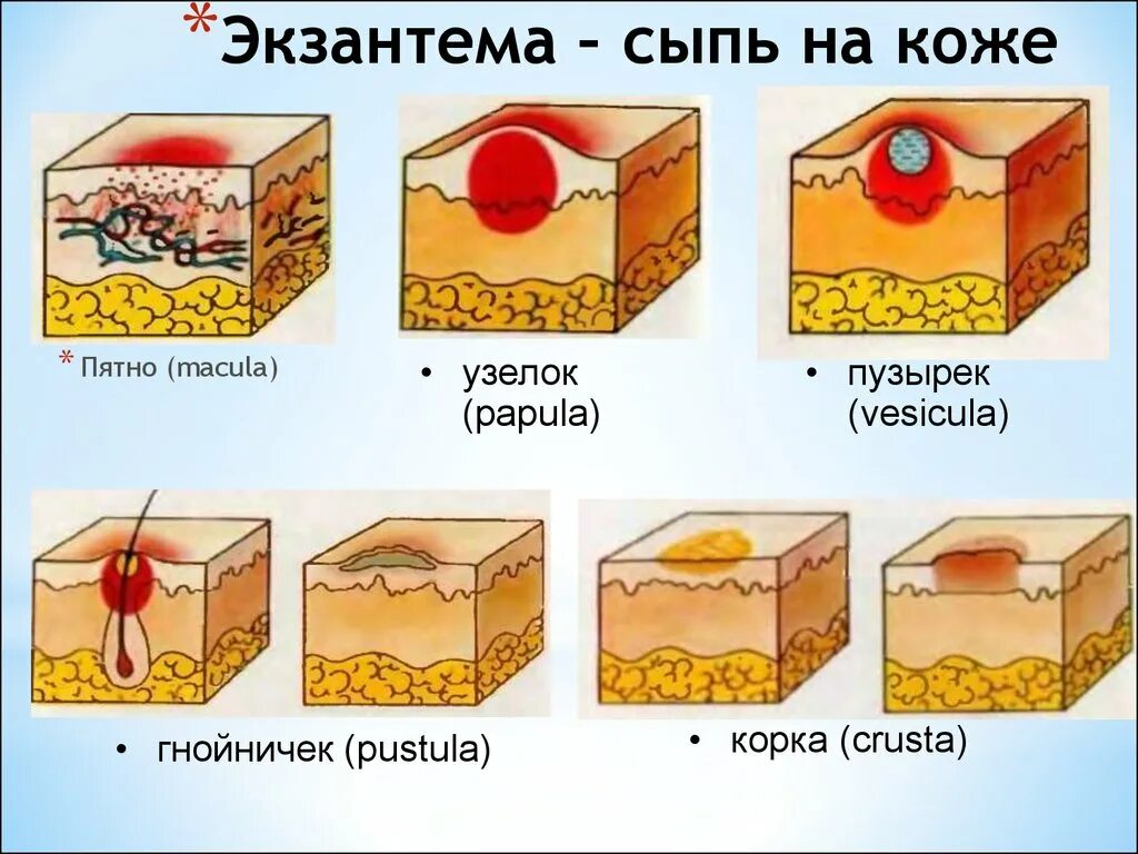 Разновидности сыпи с фото и описанием Морфологические элементы высыпаний