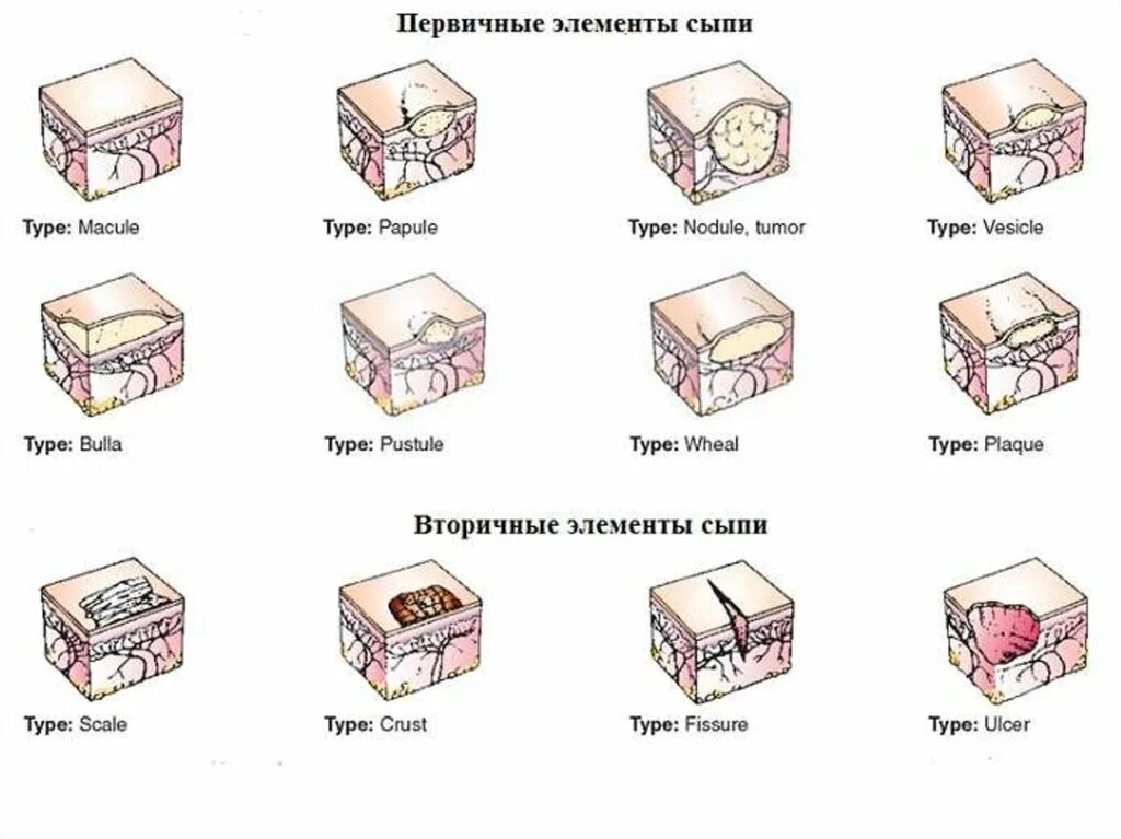 Разновидности сыпи с фото и описанием Первичная и вторичная сыпь: найдено 90 изображений