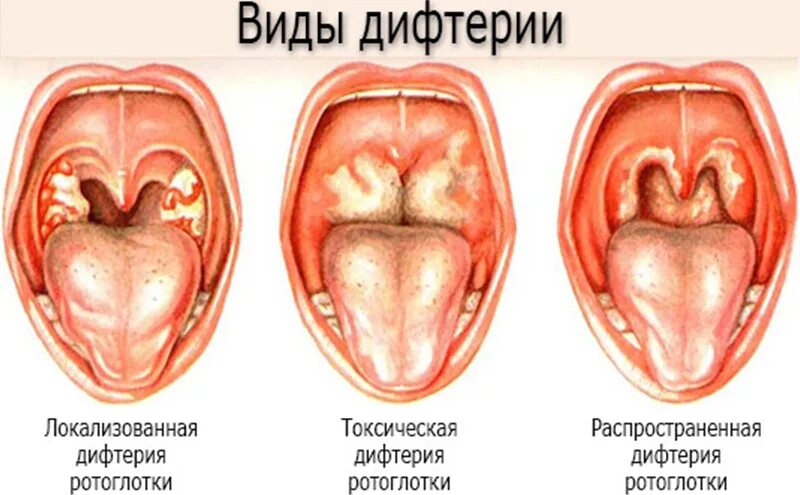 Разные болезни горла фото Дифтерия: симптомы, лечение, профилактика 1ДМЦ