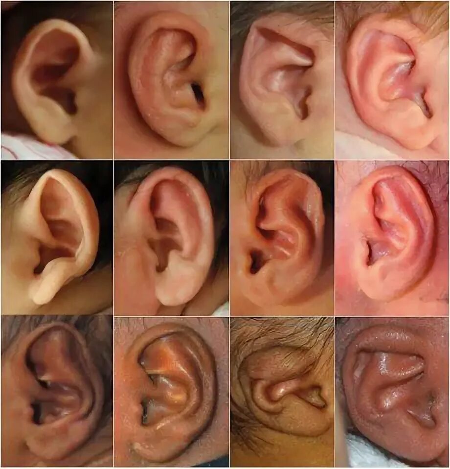 Разные уши фото Doctors nonsurgically correct infant ear deformities - ScienceBlog.com