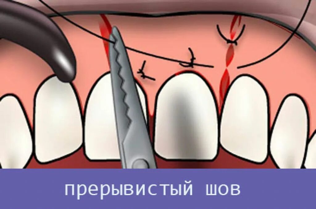 Разошлись швы как выглядит зуб Зашили зуб ниткой