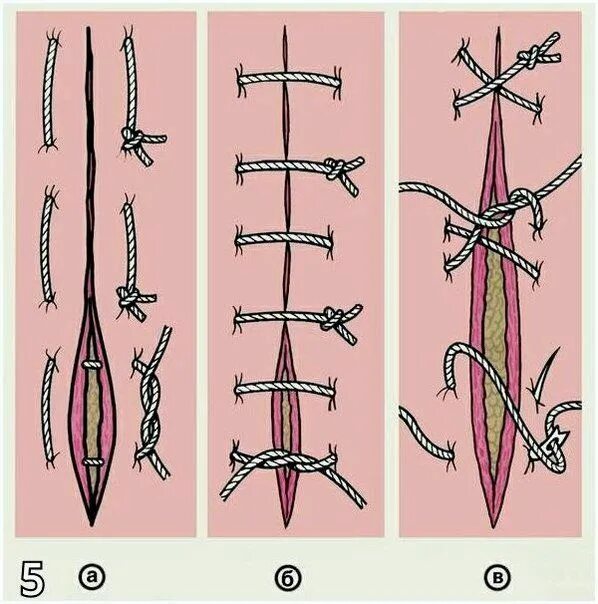 Разошлись швы как выглядит зуб Как правильно зашивать рану Surgical suture, Medical knowledge, Emergency medici