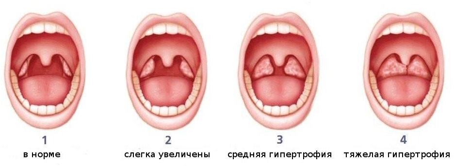 Разрастание лимфоидной ткани миндалины фото Тонзиллит острый и хронический: лечение тонзиллита у взрослого и ребенка