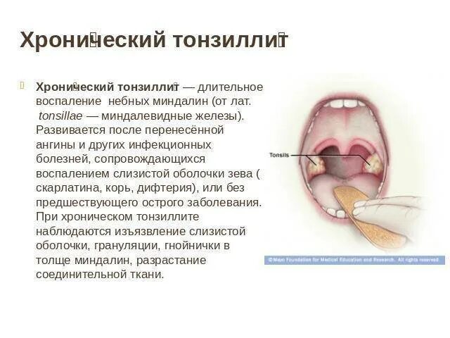 Разрастание лимфоидной ткани миндалины фото Причины воспаления гланд, увеличения миндалин у грудничков: симптомы, как вылечи