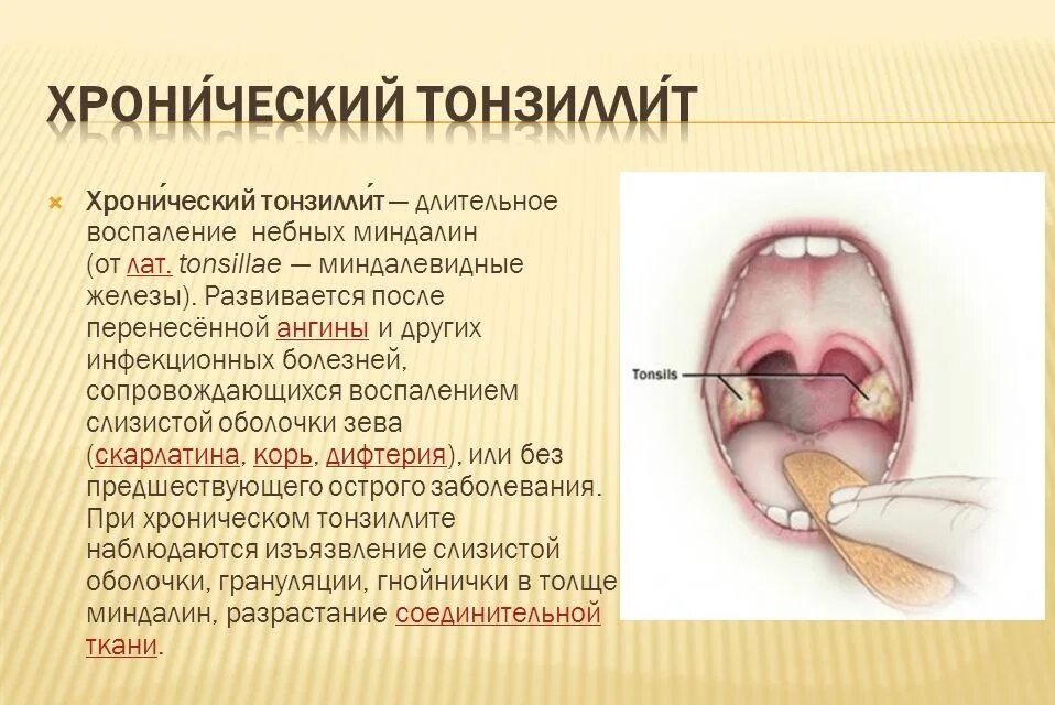 Разрастание лимфоидной ткани в горле фото Вечно больное горло и ангины: что такое хронический тонзиллит и удалять ли минда