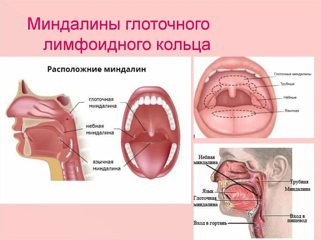 Разрастание лимфоидной ткани в горле фото Увеличение глоточной миндалины