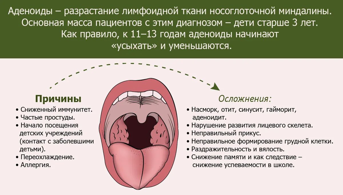 Разрастание лимфоидной ткани в горле фото Увеличение глоточной миндалины