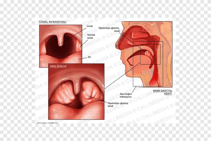 Разрастание лимфоидной ткани в горле фото Free download Tonsillitis Pharyngitis Otorhinolaryngology Adenoid, tonsil, love,