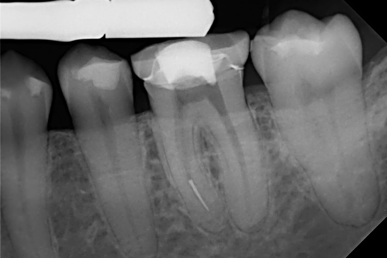 Разрушение зуба более 50 процентов как выглядит Удаление отломанного инструмента из канала зуба
