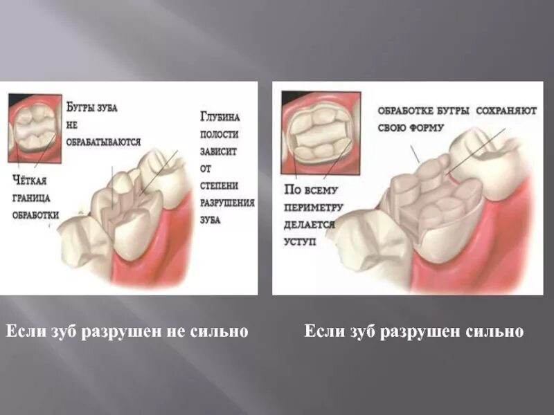 Разрушение зуба более 50 процентов как выглядит Zameschenie_defektov_koronki_zuba_koronkovymi_vkl