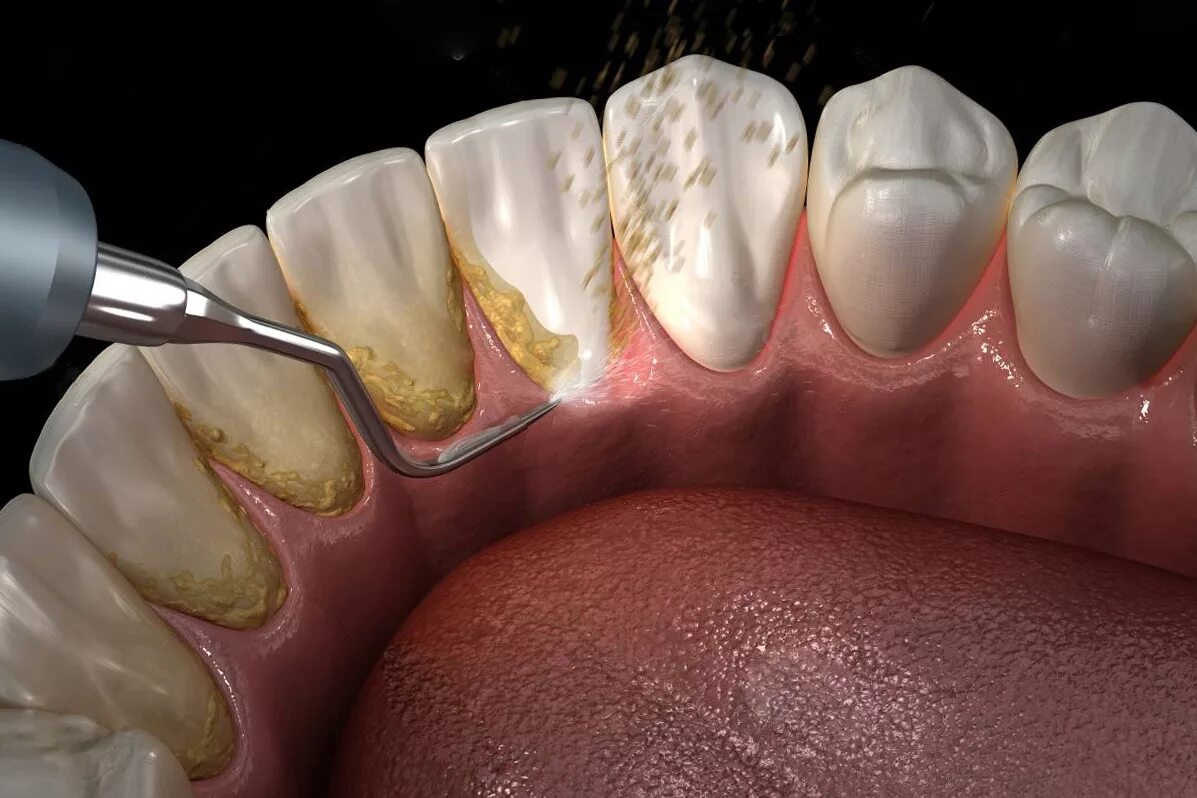Разрушение зуба более 50 процентов как выглядит Ультразвуковая чистка зубов - цены в Москве в стоматологии OneDent.ru