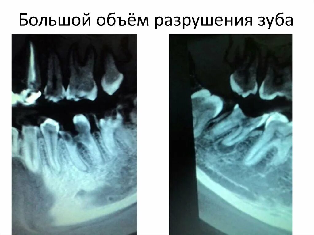 Разрушение зуба фото Удаление зубов - презентация онлайн