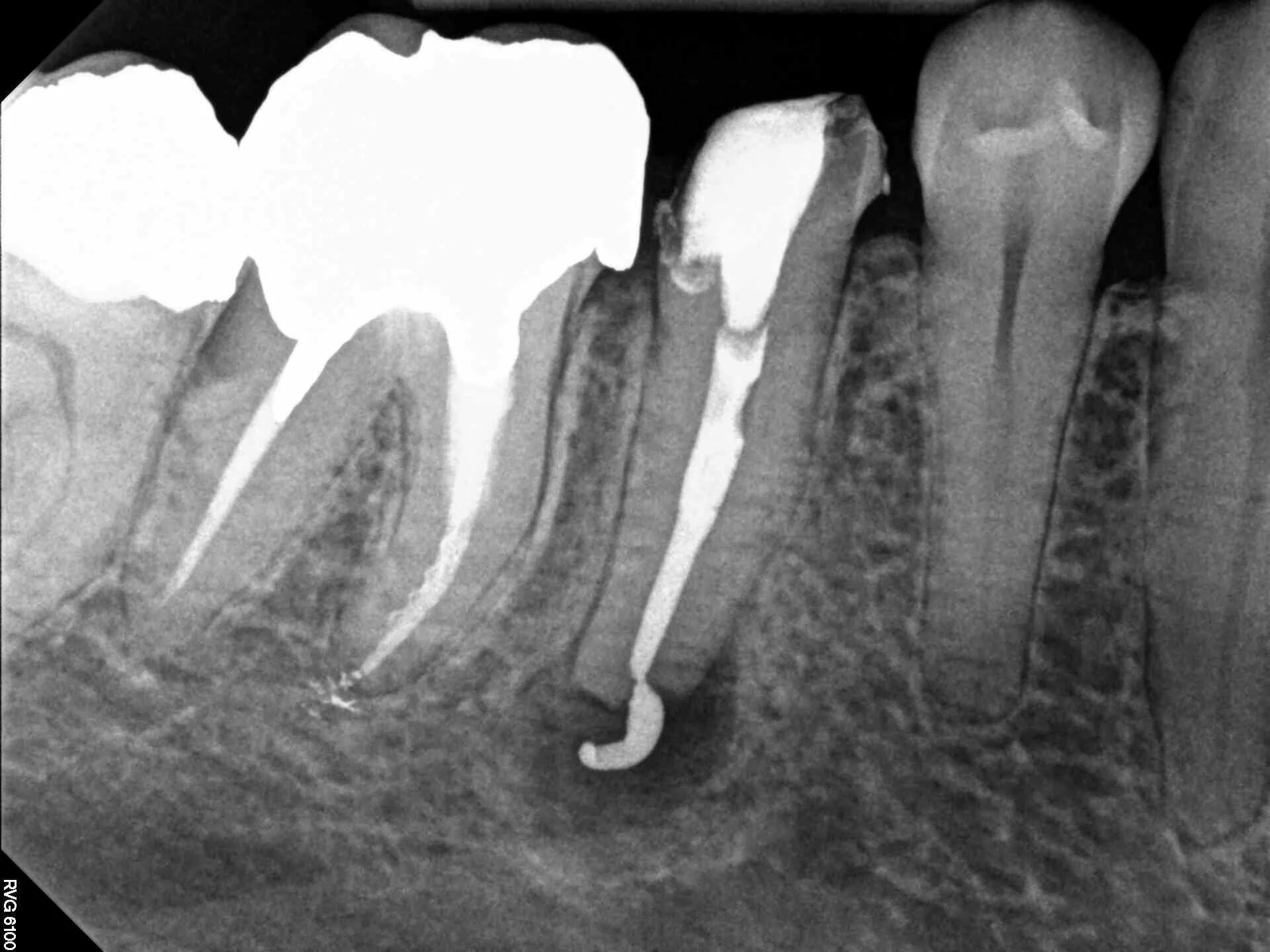 Разрушение зуба фото This Patient Chose Orthograde Endodontic Revision Procedure on his Mandibular Pr