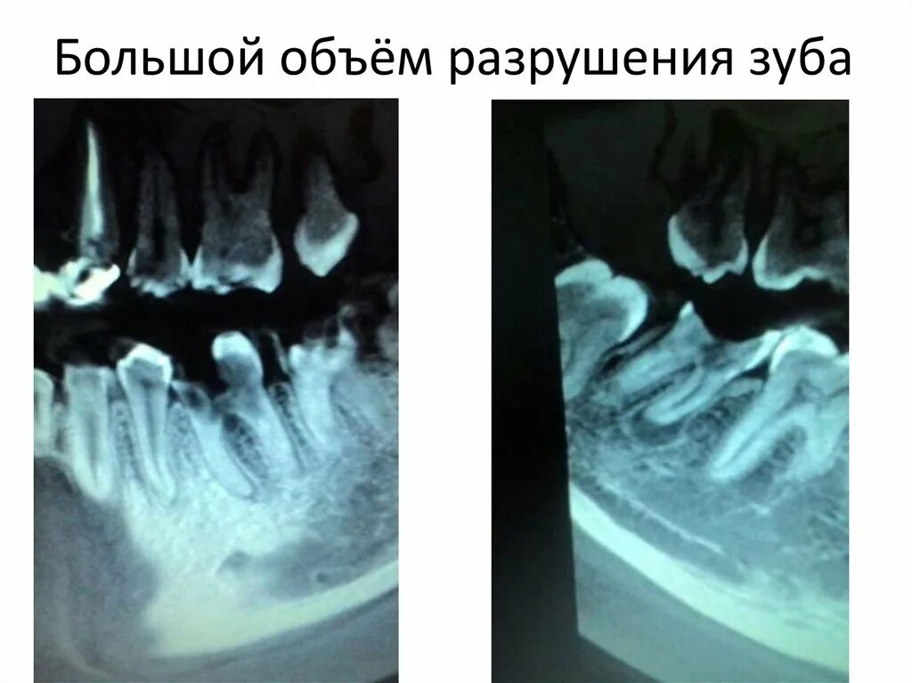 Разрушенный зуб фото Удаление зубов - презентация онлайн