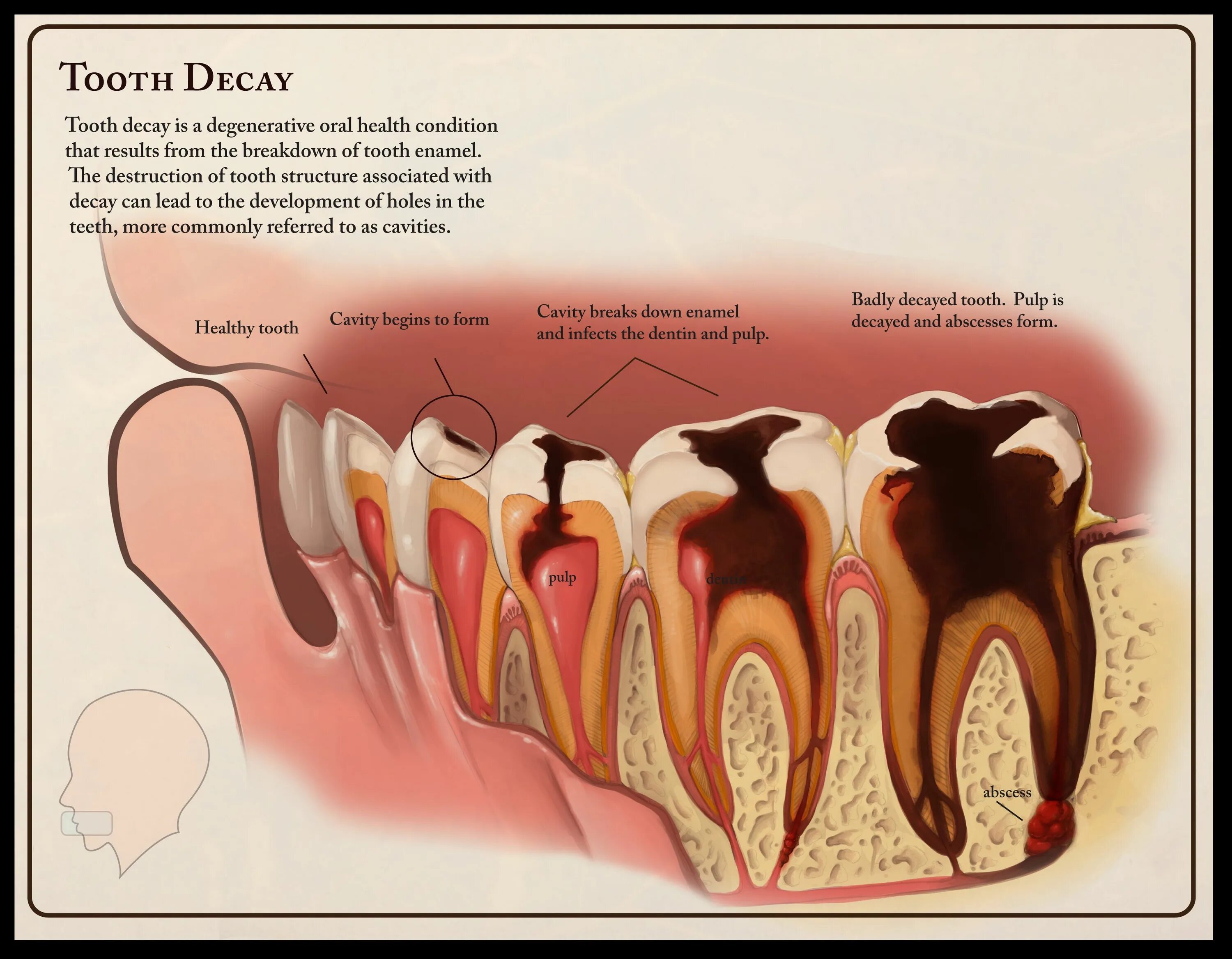 Разрушенный зуб фото tooth decay Dental care for kids, Tooth decay, Dental decay