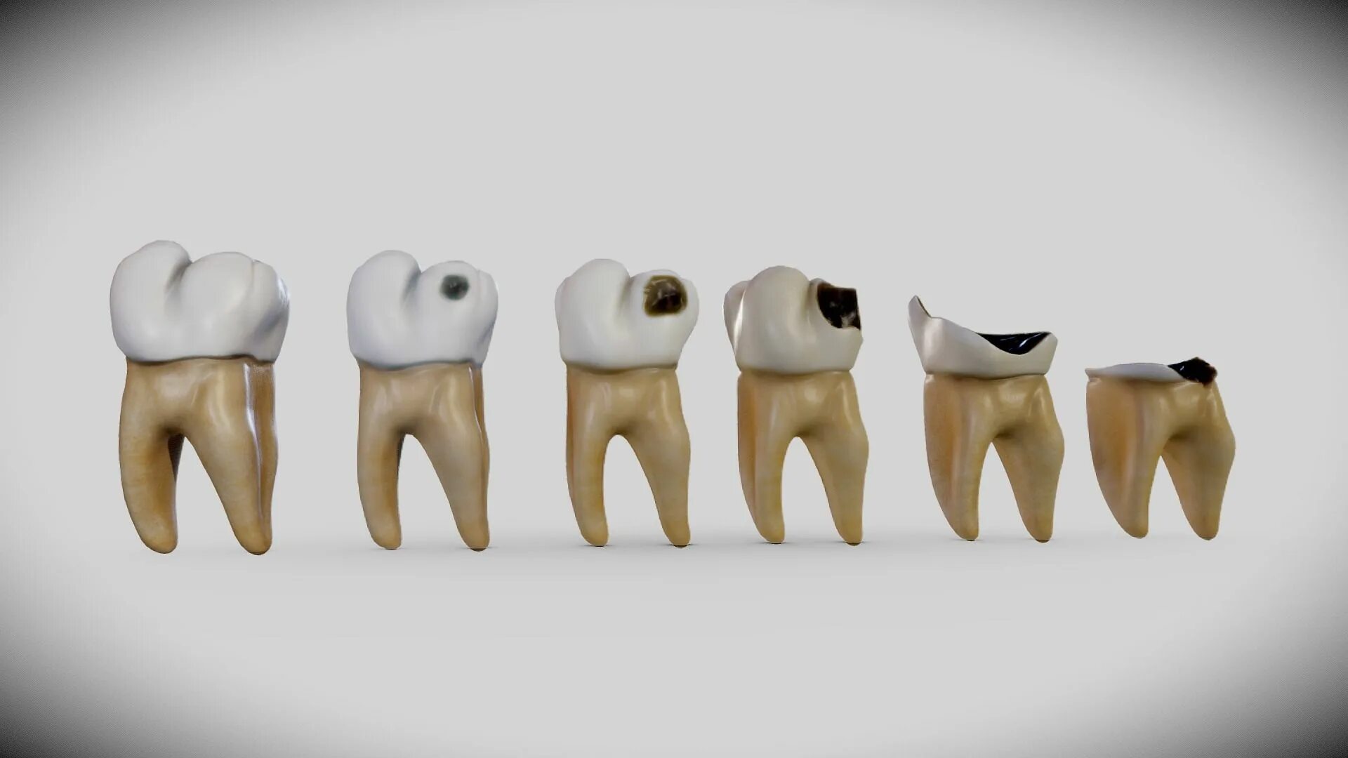 Разрушенный зуб фото Tooth Decay Progression (Dental Caries) Dental caries, Dental, Tooth decay