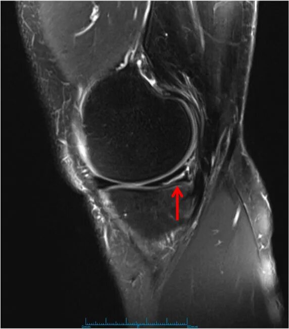 Разрыв мениска коленного сустава симптомы фото Medial Meniscus Tear Knee Specialist Minnesota