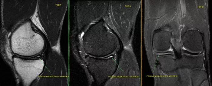 Разрыв мениска коленного сустава симптомы фото Разрыв заднего рога медиального мениска коленного сустава, лечение горизонтально