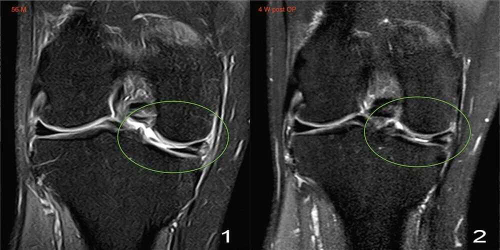 Разрыв мениска коленного сустава симптомы фото Posterior Horn Medial Meniscus Tear - Wirbelsäulen und Gelenke Zentrum München