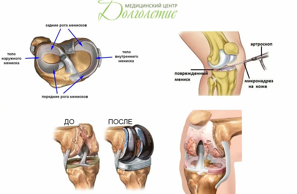 Разрыв мениска коленного сустава симптомы фото Где находится мениска фото: найдено 81 изображений