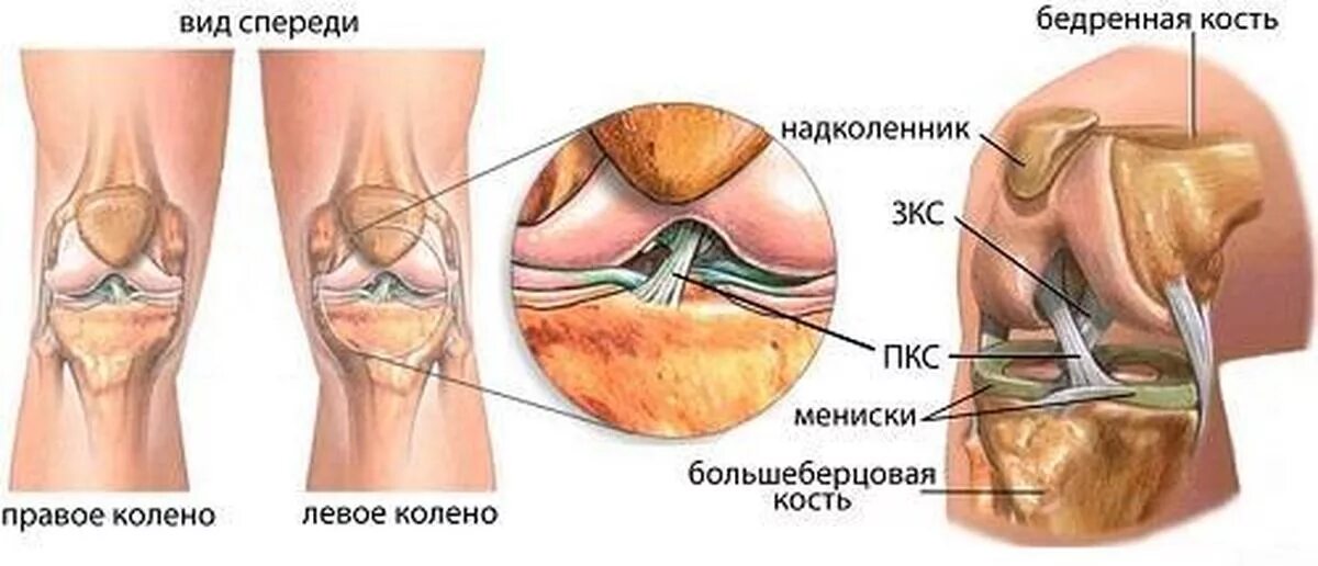 Застарелое повреждение связок