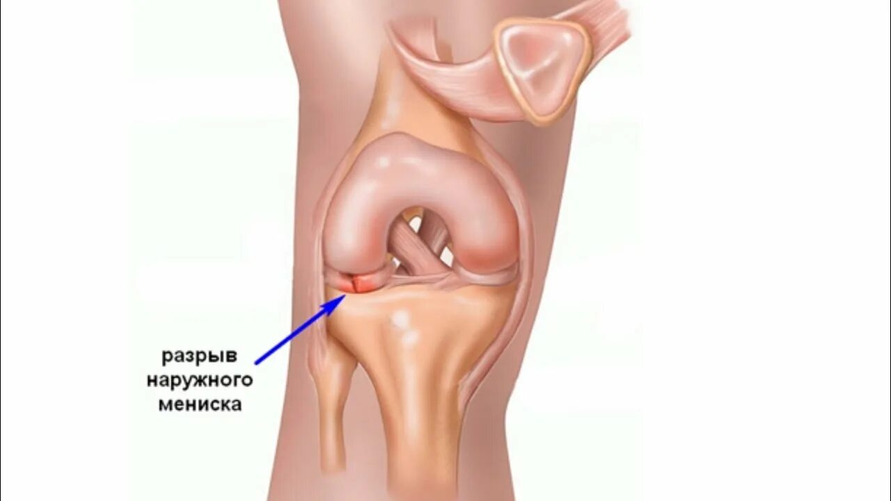 Разрыв мениска коленного сустава симптомы фото Если Болит колено. Лечение мениска коленного сустава самостоятельно! - YouTube