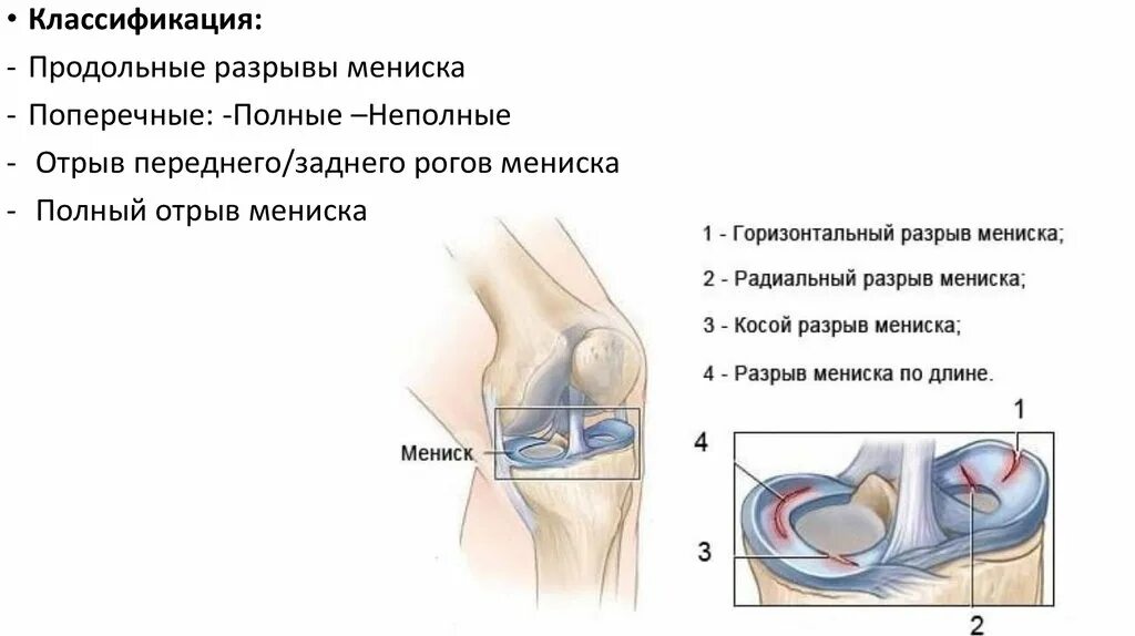 Разрыв мениска коленного сустава симптомы фото При разрыве мениска можно ходить