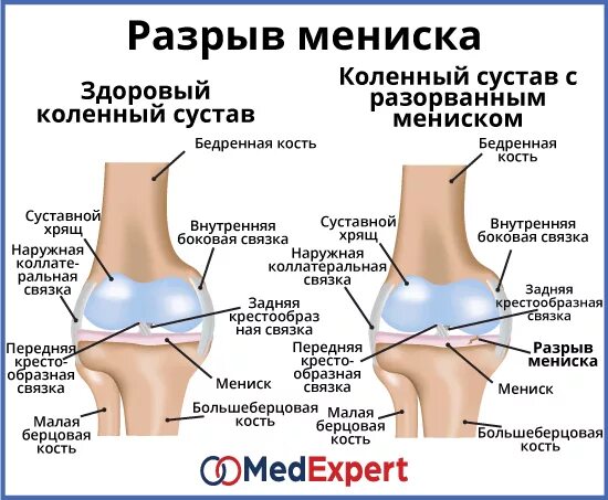 Разрыв мениска коленного сустава симптомы фото Разрыв коленного мениска что делать