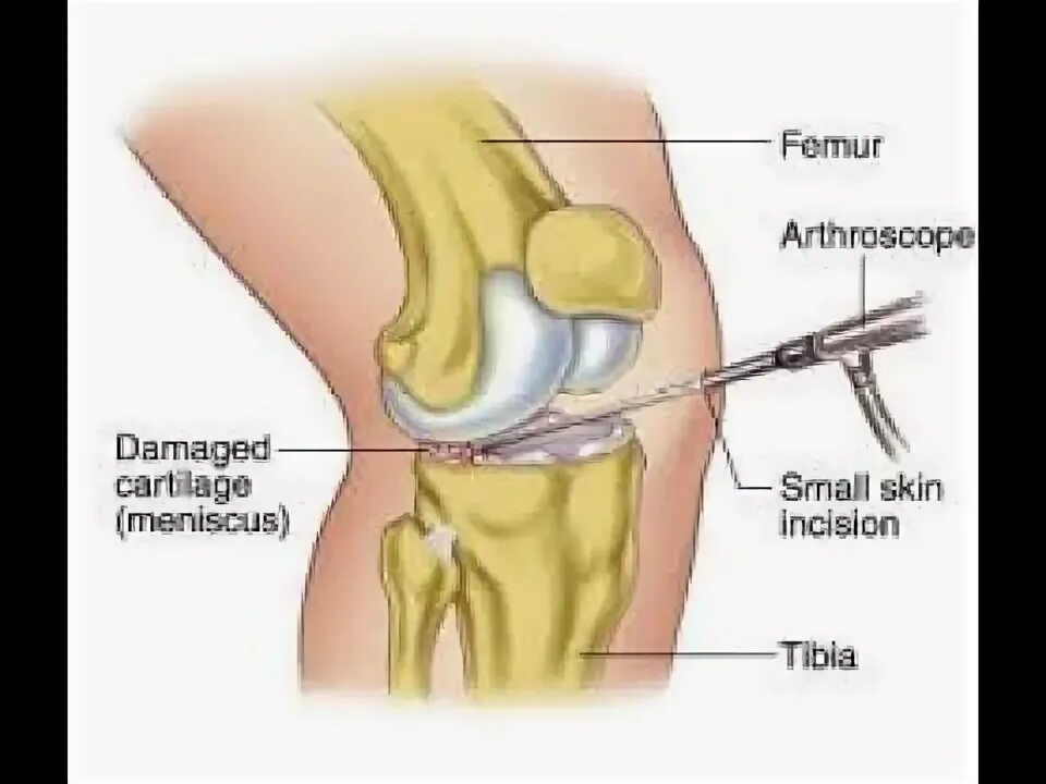 Разрыв мениска коленного сустава симптомы фото Meniscectomy, arthroscopic knee surgery. What to expect - YouTube