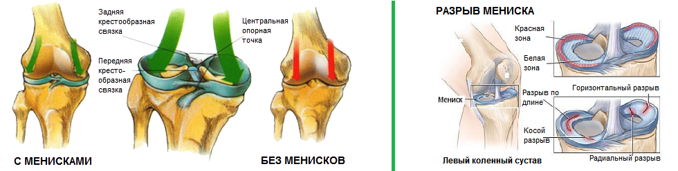 Разрыв мениска симптомы фото Поражение менисков коленного сустава Симптомы и лечение