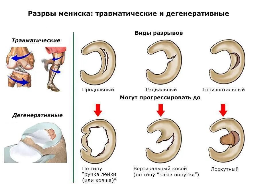 Разрыв мениска симптомы фото Реабилитация после травмы коленного сустава Блог центра реабилитации Лесной