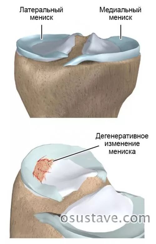 Застарелое повреждение связок