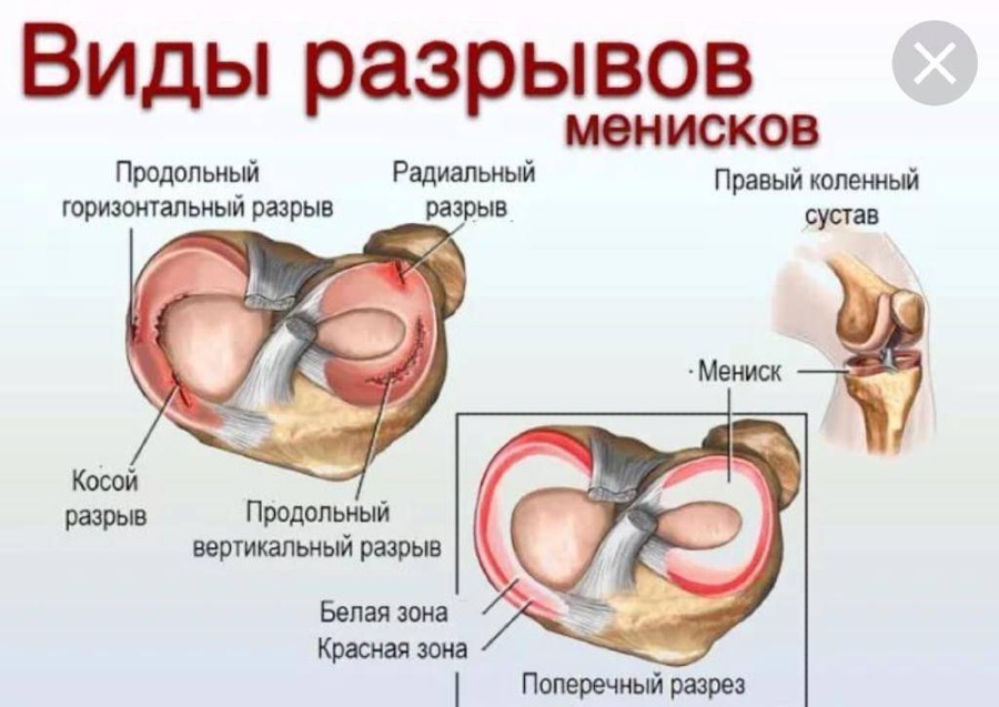 Разрыв мениска симптомы фото Разрыв мениска - симптомы, диагностика, лечение