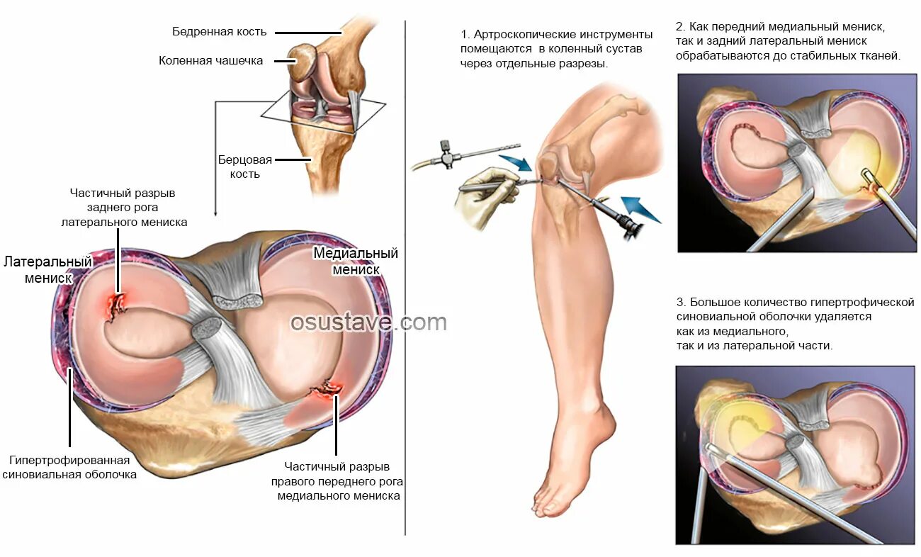 Разрыв мениска симптомы фото Повреждение мениска коленного сустава. Симптомы, лечение и профилактика