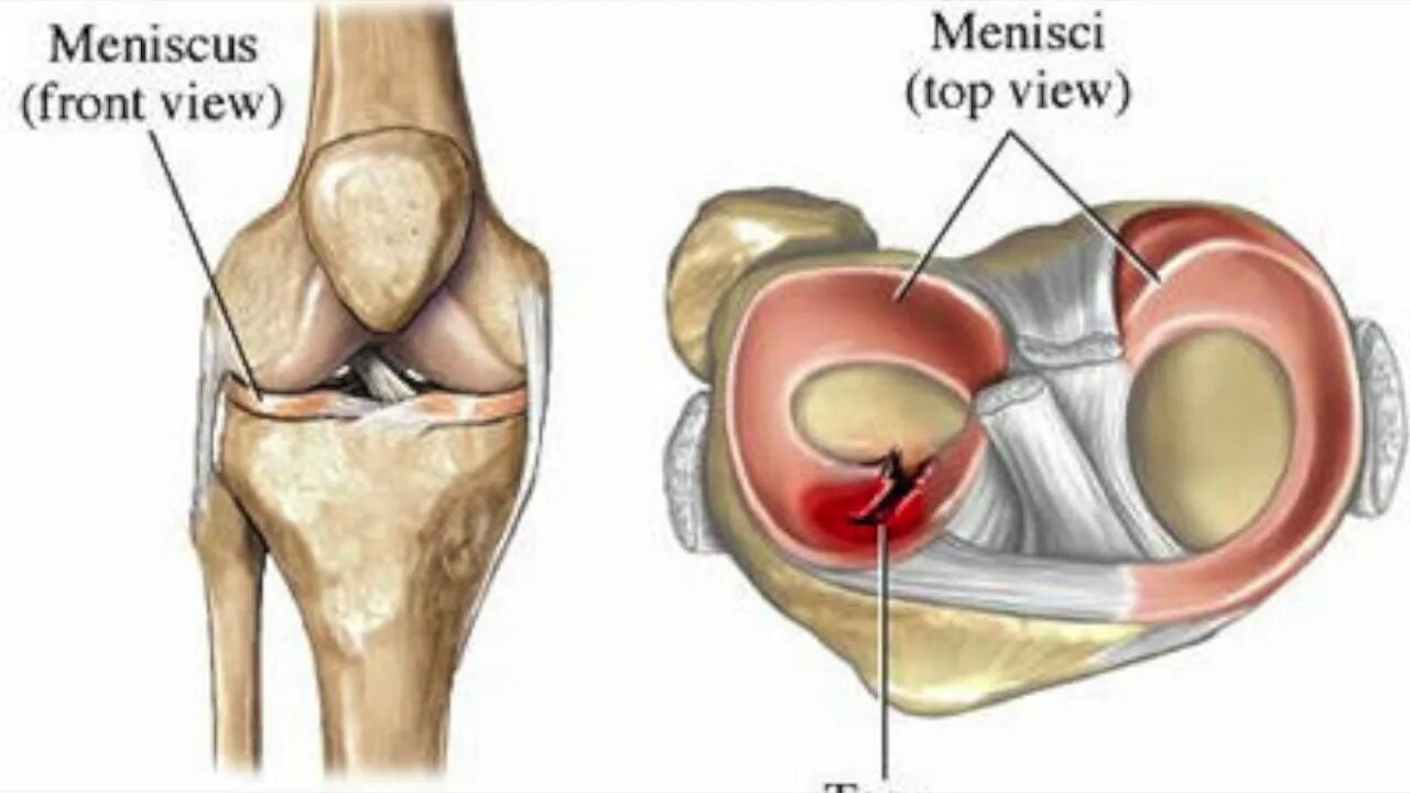 Разрыв мениска симптомы фото Разрыв коленного мениска что делать