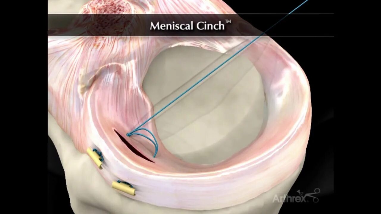 Разрыв мениска симптомы фото Szycie łąkotki - artroskopia kolana - YouTube