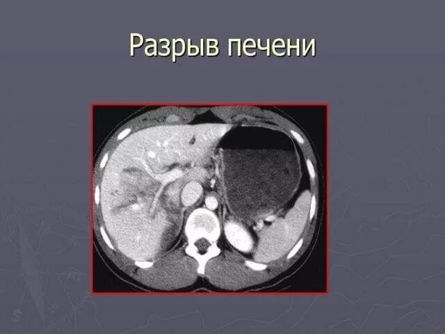 Разрыв печени фото Боль вверху живота - Боль вверху живота: причины, диагностика, лечение, препарат