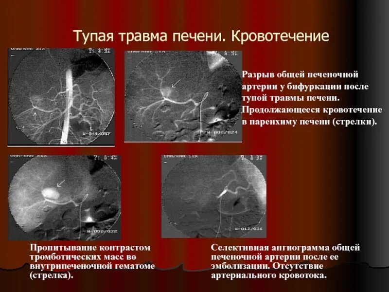 Разрыв печени фото ИНТЕРВЕНЦИОННАЯ РАДИОЛОГИЯ(ИР) презентация, доклад