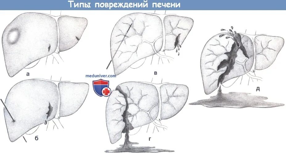 Разрыв печени фото Показания, этапы и техника операции при разрыве печени