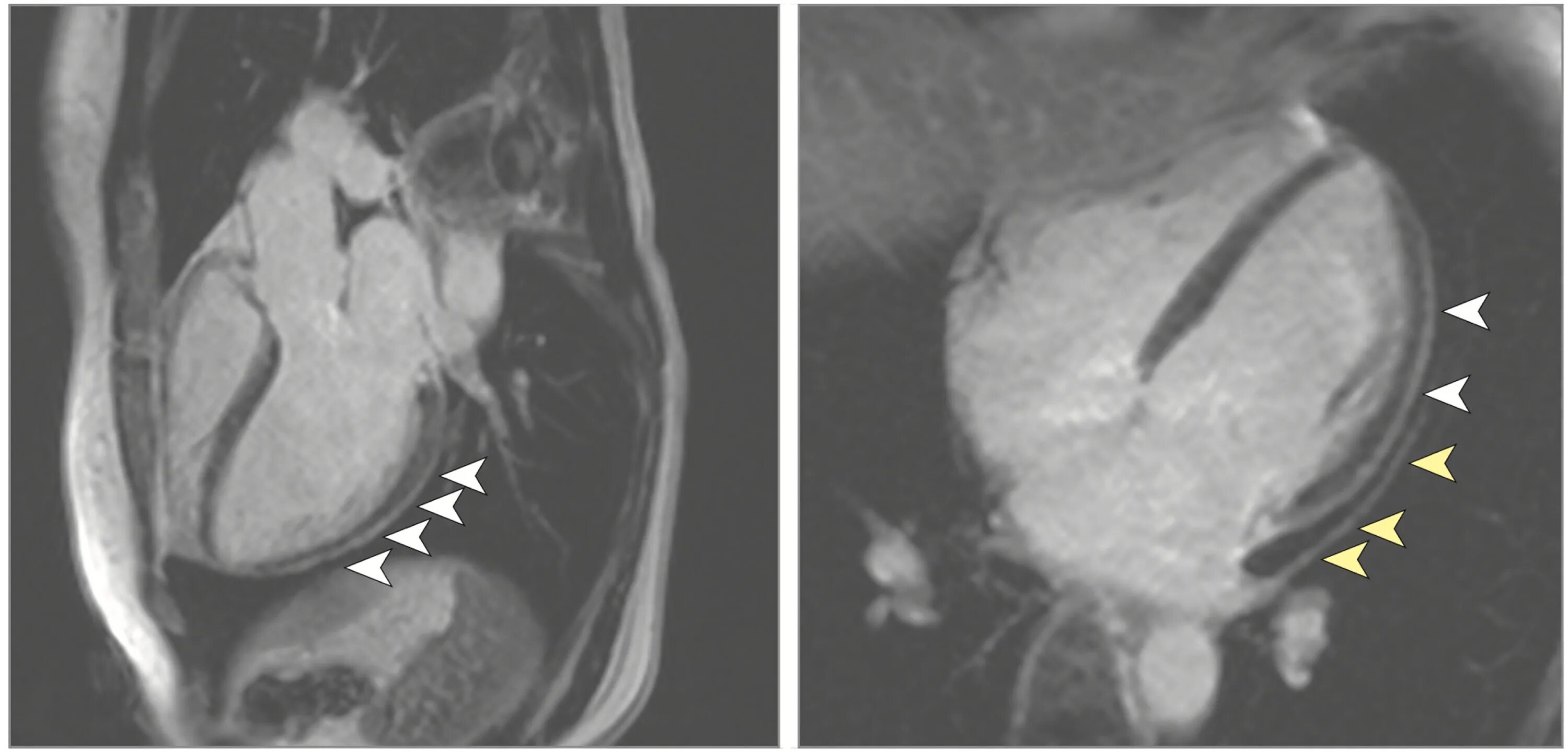 Разрыв сердца фото Diagnostics Free Full-Text Cardiac MRI and Myocardial Injury in COVID-19: Diagno