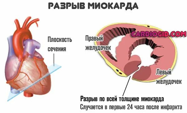 Разрыв сердца фото Разрыв сердца от испуга: миф или реальность - Центр охраны материнства и детства