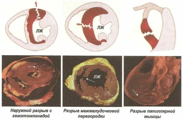 Разрыв сердца фото Разрыв сердца: причины, симптомы, лечение
