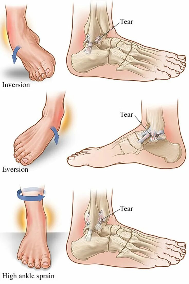 Разрыв связок голеностопного сустава фото симптомы Ушиб связок голеностопного сустава
