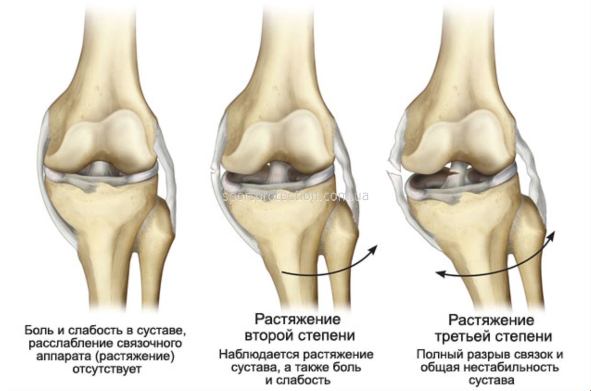 Разрыв связок коленного сустава симптомы фото Травмы связок колена