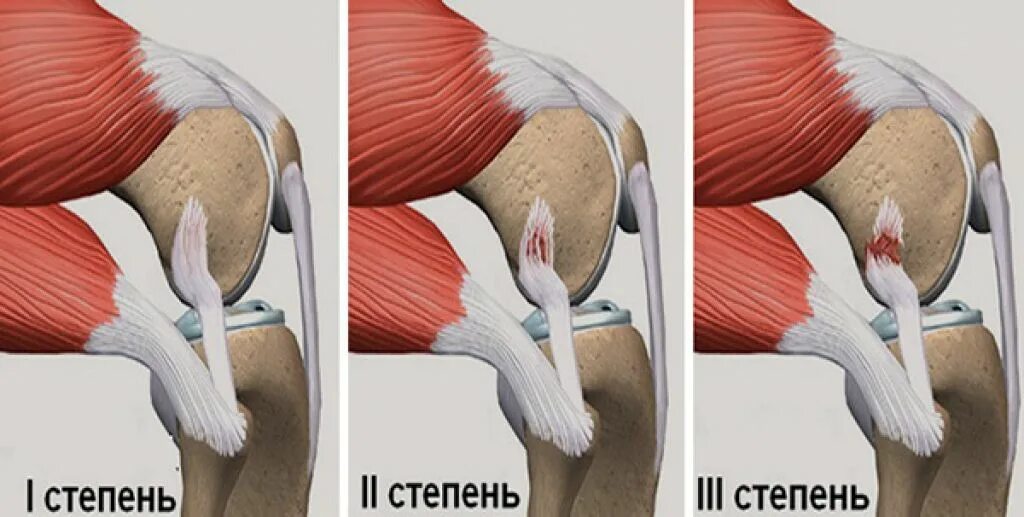 Разрыв связок коленного сустава симптомы фото Растяжение мышц коленного