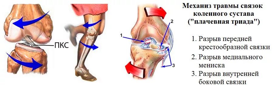 Разрыв связок коленного сустава симптомы фото Картинки КОЛЕННЫЕ КРЕСТОВЫЕ СВЯЗКИ